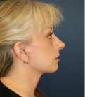 Feel Beautiful - Face Lift San Diego 50 - After Photo